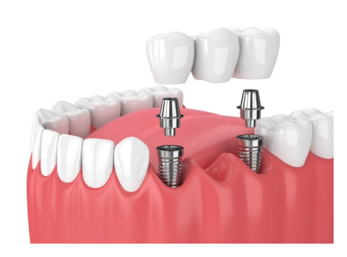 implant bridge