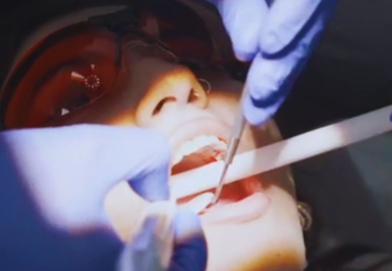 NHS dental extraction