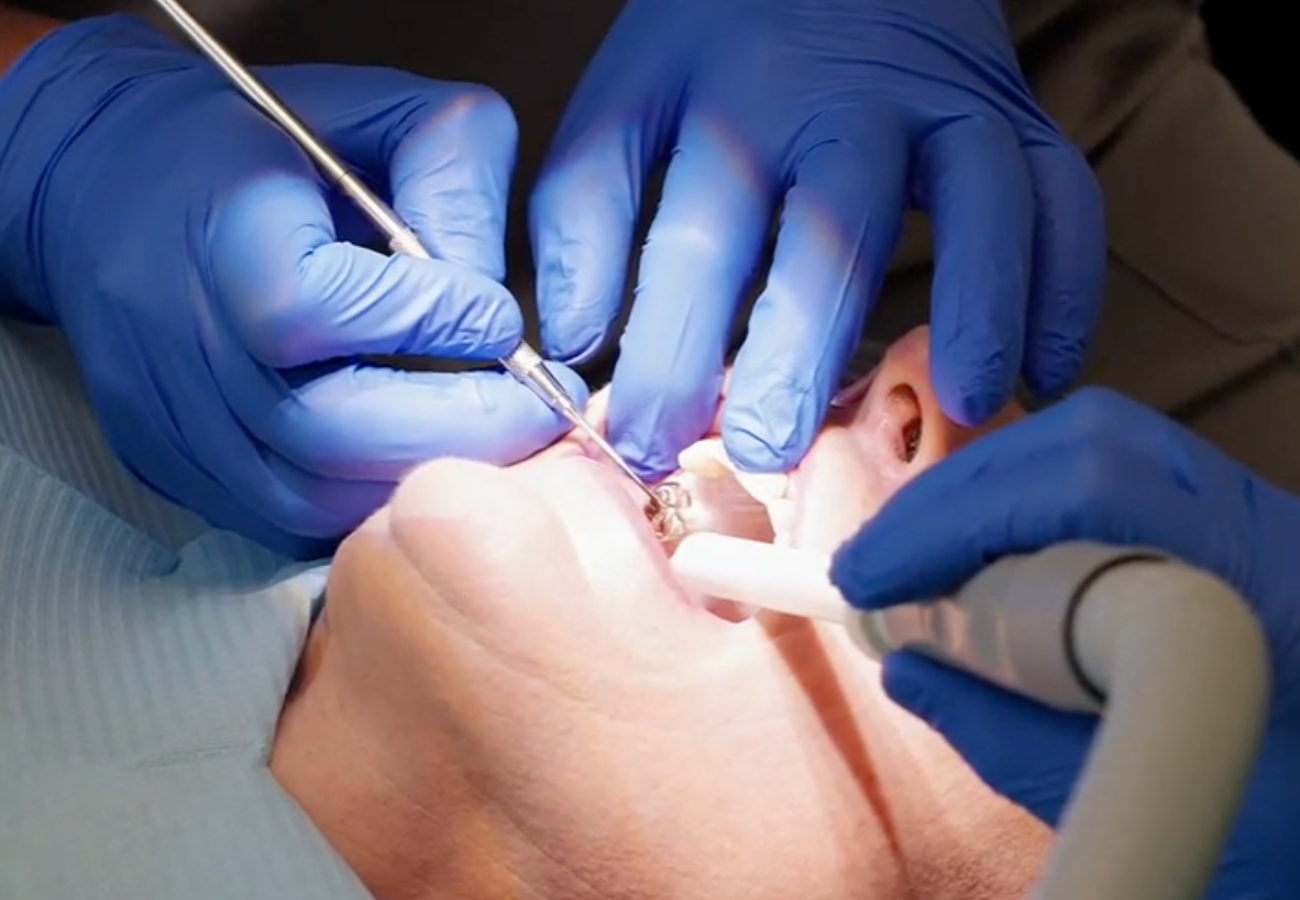 dental implants Whetstone